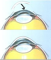 Trépanation de la cornée Ablation de la cornée opaque